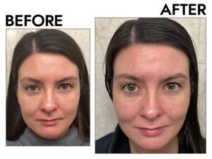 byr-anti-aging-serums-test-clinique-wrinkle-correcting-before-after-maggie-andrew-f614fb1f40e54419be6679433882e8fd