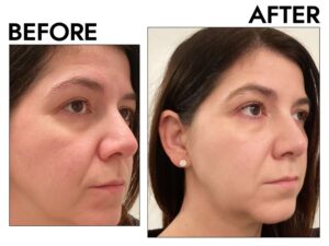 byr-anti-aging-serums-test-macarene-before-after-michelle-garza-72f488babb9c4a2facdda71705d942af