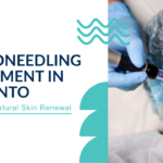 Microneedling Treatment in Toronto
