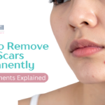 How to Remove Acne Scars Permanently