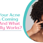 Why Your Acne Keeps Coming Back